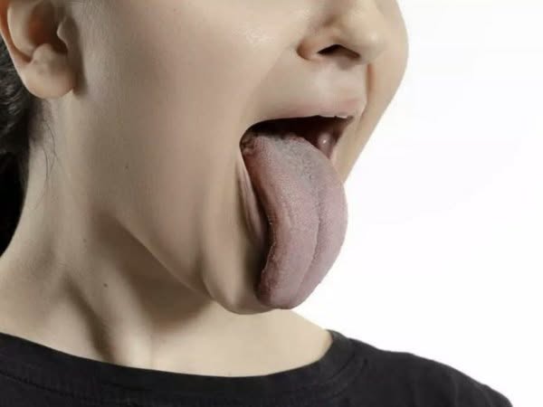 Почему темный налет на языке требует срочного визита к врачу